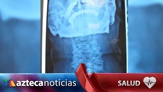 Hormigueo y rigidez en manos y piernas puede ser cervical estrecha [upl. by Venu]