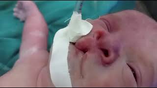 multiple congenital anomalies again in our nicu  drtmam [upl. by Nosnarb]