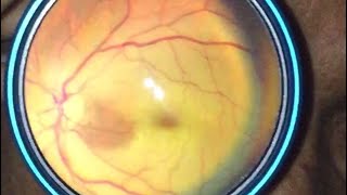 Cherry Red Spot  Central Retinal Artery Occlusion CRAO Indirect Ophthalmoscopy using Smartphone [upl. by Eannaj653]