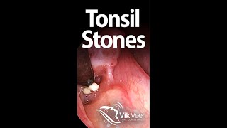 Tonsil stones forming in a large tonsil fissure [upl. by Nylsirhc]