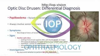 Optic Disc Drusen Part 2 Preview [upl. by Norris]