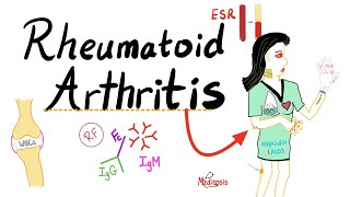 Rheumatoid Arthritis RA  Autoimmune Disease  Definition Etiologyamp Epidemiology  Rheumatology [upl. by Hoopen]