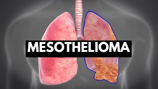 MESOTHELIOMA Causes Signs and Symptoms Diagnosis and Treatment [upl. by Nonnair642]