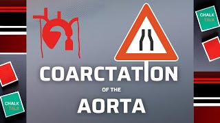 Coarctation of the aorta [upl. by Kilby]