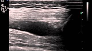 Suprapatellar recess knee on ultrasound [upl. by Hogan]