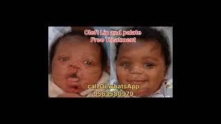 CLEFT LIP AND PALATE TREATMENT FREE IN SILIGURI shorts cleftsurgery cleftpalate [upl. by Leibman]