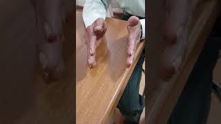 Resting Tremors of Right Hand in Parkinsons Disease [upl. by Ahsienel176]