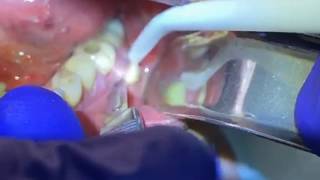 Draining a Dental Abscess  Advanced Dental Care [upl. by Silado]