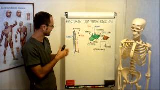 umh1729 201213 Lec018 Fracturas tibia peroné tobillo y pie [upl. by Analem]