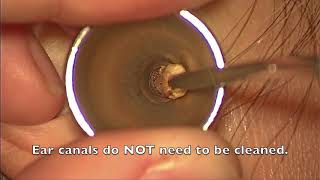 Ear Wax Extraction  St Pauls Hospital [upl. by Ezeerb]