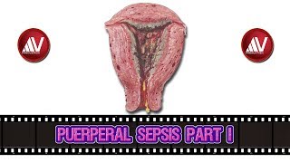 Puerperal Sepsis Part I [upl. by Niu]