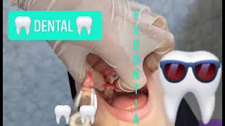 Extraction of maxillary first premolar for orthodontic treatment🦷🦷🦷🦷 Maxillary Exodontia techniques [upl. by Fulton]