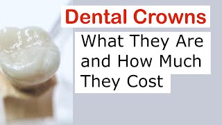 Dental Crowns What They Are and How Much They Cost [upl. by Cherry]