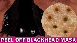 BLACKHEAD REMOVAL UNDER A MICROSCOPE [upl. by Drahnreb]