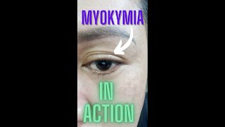 SEE MYOKYMIA IN ACTION  Eyelid Twitching shorts [upl. by Orlando]