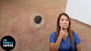 85 Year Old Blackhead Dr Pimple Popper Most Popular Pop of ALL TIME [upl. by Marika80]