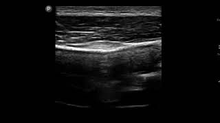 Knee Ultrasound Iliotibial IT Band Injection [upl. by Airol]