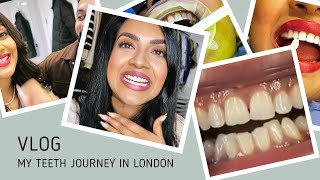 Teeth Transformation  Vithya Hair and Makeup [upl. by Chernow]