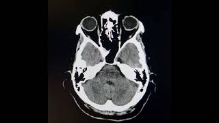 Reversible posterior leukoencephalopathy syndrome [upl. by Aicilehp]