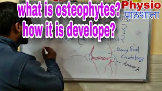 Osteophytes how it is develope [upl. by Daggna]