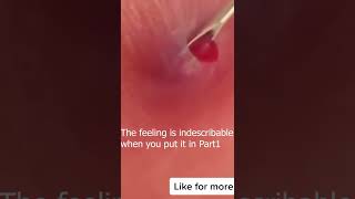 pimple popping 2022 new blackheads on noseacne treatment at home for oily skinshortscrazyacne [upl. by Nagaem]