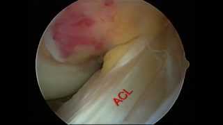 Knee Arthroscopy  Dr Paul Siffri [upl. by Marienthal]