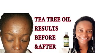 HOW TO USE TEA TREE OIL FOR PIMPLES ACNE AND SPOTS DEFINITIVELY IN 2024  NIGHTSKIN ROUTINE [upl. by Hpesoy]