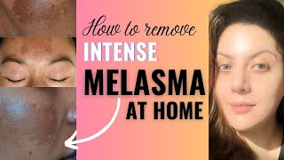 How to Remove Melasma from Face Permanently at Home I Melasma Removal Treatment [upl. by Selinda]