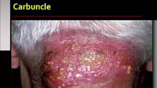 Bacterial Infections of the Skin [upl. by Lorna771]