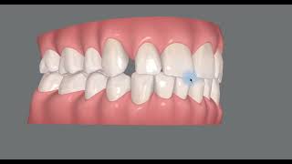 Mandibular Advancement Device Side Effect Correction with Invisalign [upl. by Lyon]