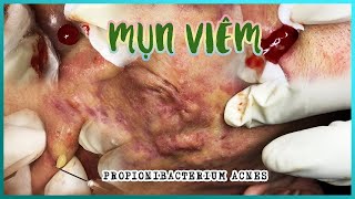 Big Cystic Acne Blackheads Extraction Blackheads amp Milia Whiteheads Removal Pimple Popping [upl. by Thackeray]