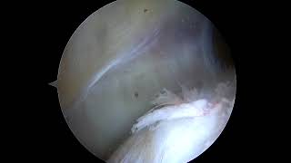 Knee Arthroscopy plica syndrome KlM 1 [upl. by Carolynne]