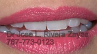 Estetica DentalProstodoncistaImplantes Dentales en Puerto Rico7877730123 [upl. by Staten2]