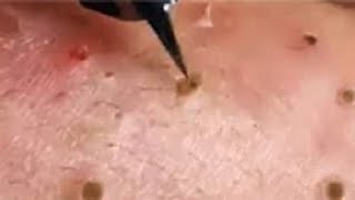 Full Giant Blackheads Popping Video Blackheads Removal 2019 [upl. by Macey123]