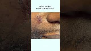 REMOVING VERTICAL TRIBAL MARKS  DR TANVEER JANJUA NEW JERSEY [upl. by Azaleah]