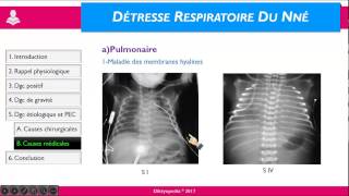 Détresse respiratoire du NN [upl. by Anni]