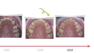 Class II Treatment with U1 Ankylosis｜【Chris Chang Ortho】CC755 [upl. by Adnorat850]