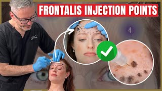 Injecting the Frontalis  Botox Injection Points amp Safety Advice [upl. by Allemaj]