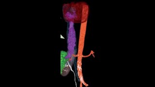 IVC leiomyosarcoma [upl. by Nedla289]