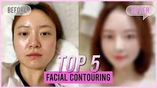 Unbelievable Dramatic Facial Contouring Jawline Reduction Cheekbone Reduction ChinBefore amp After [upl. by Norby938]