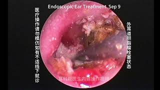 Embolization status of external auditory canal cholesteatoma [upl. by Eibo]