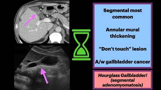 Hourglass Gallbladder Adenomyomatosis Radiology Surgery Gallbladder [upl. by Eybba]