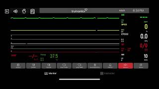 Primary Ventricular Standstill P wave Asystole [upl. by Salakcin154]