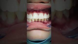 Diastema closure Dokter Gigi Cuspaeni dentalcare doktergigi veneers foryou fyp trending jjj [upl. by Nani]