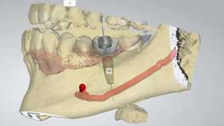 Digital Implant Dentistry [upl. by Damicke614]