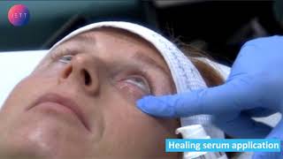 JETT PLASMA LIFT MEDICAL lower eyelids wrinkle smoothening [upl. by Glennon]