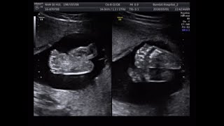 fetal ultrasound of 20 weeks 21 weeks baby boy moving [upl. by Kumagai]