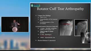 PAOS Pearl Rotator Cuff Arthropathy [upl. by Marih]