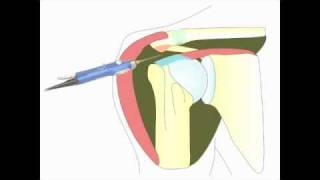 Acromioplastie arthroscopique de lépaule pour tendinite [upl. by Cirad]