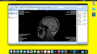 MicroDicom DICOM Viewer on macOS Sequoia using Wine [upl. by Bobbette]